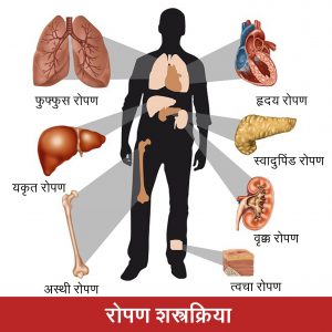 Read more about the article रोपण शस्त्रक्रिया (Transplantation surgery)
