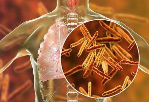 Read more about the article क्षयरोग जीवाणू  (Mycobacterium tuberculosis)