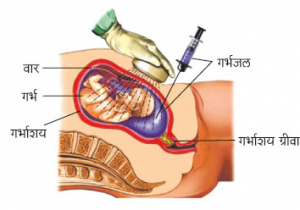 गर्भजलचिकित्सा (Amniocentesis)