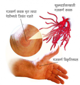 Read more about the article गजकर्ण (Ringworm)