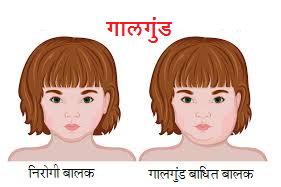 Read more about the article गालगुंड (Mumps)