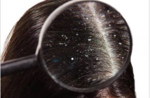 Read more about the article कोंडा (Dandruff)