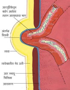 Read more about the article अंतर्गळ (Hernia)