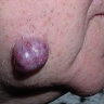 अर्बुद (Tumour)