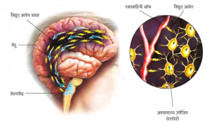 Read more about the article अर्धशिशी (Migraine)