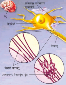 Read more about the article अल्झायमर विकार (Alzheimer disease)