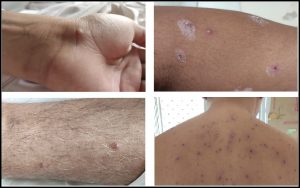 Read more about the article कांजिण्या (Chickenpox/Varicella)