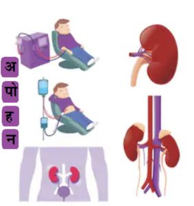 Read more about the article डायलॅसिस (Dialysis)