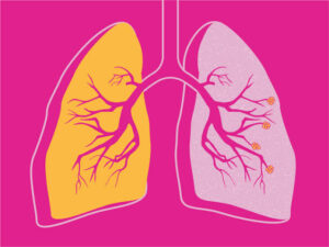 दीर्घकालीन अवरोधी फुप्फुसरोग (Chronic Obstructive pulmonary diseases)