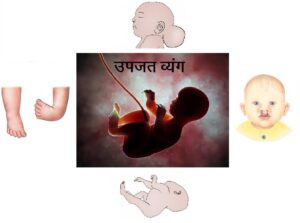 Read more about the article उपजत व्यंग (Congenital Anomalies)
