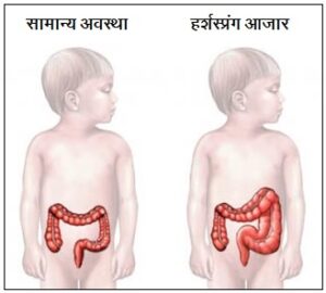 Read more about the article हर्शस्प्रंग आजार  (Hirschsprung’s disease)