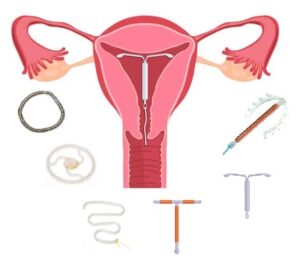गर्भस्थ गर्भनिरोधक साधने (Intrauterine contraceptive devices, IUD)