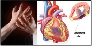 Read more about the article हृद्स्नायु अभिशोष आणि परिचर्या (Emergency Nursing Care of myocardial infarction)