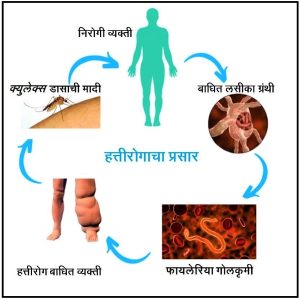 Read more about the article हत्तीरोग (Elephantiasis)