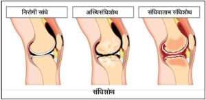 Read more about the article संधिशोथ (Arthritis)