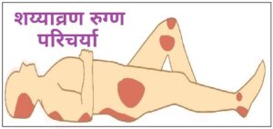 Read more about the article शय्याव्रण रुग्ण परिचर्या (Bedsore Patient Nursing)