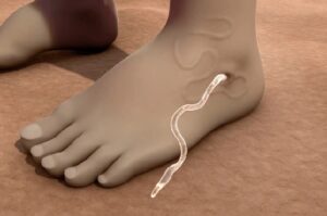 नारू / गिनी वर्म ( Guinea worm/ Dracunculiasis)