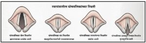 Read more about the article घोषत्व (Voicing)